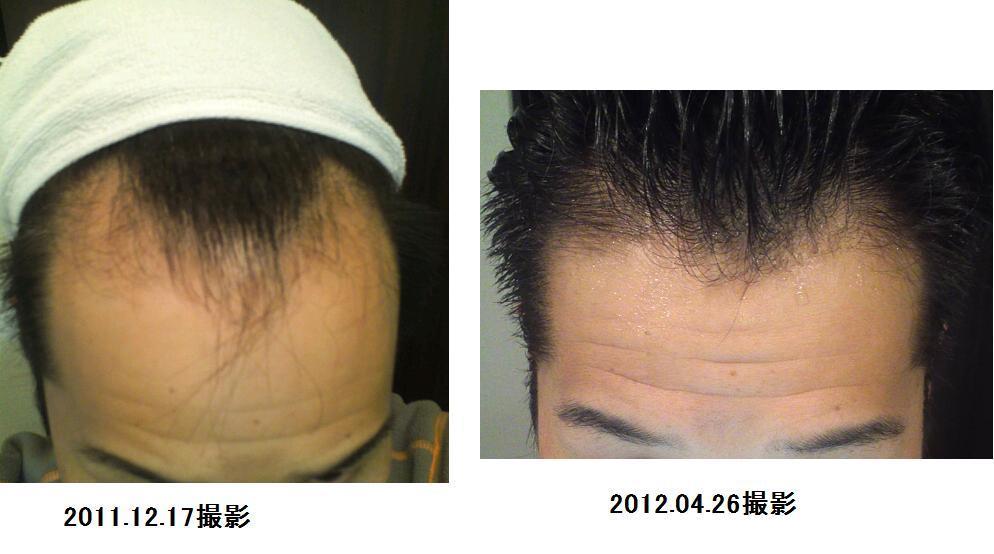 35才でハゲ プロペシア フィンペシア でハゲを克服した 発毛効果体験談 裏技ａｇａ治療費用 30代の薄毛復活
